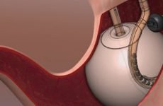 Внутрішньошлунковий балон для схуднення: переваги