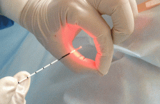 Припікання виразки шлунка лазером: протипоказання