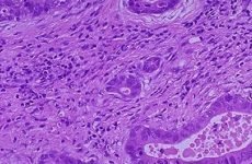 Перстневідноклеточний рак шлунка: прогноз, лікування, стадії