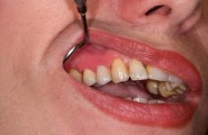 Тимчасові зубні протези: різновиди, показання, імплантація