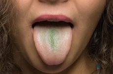 Зелений наліт на язиці: причини виникнення та методи лікування