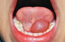 Під язиком міхур: причини виникнення, симптоми і методи лікування