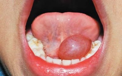 Під язиком міхур: причини виникнення, симптоми і методи лікування