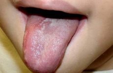 У дитини болить язик: причини, симптоми і методи лікування