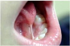 Пластика вуздечки язика у дітей лазером: показання та протипоказання