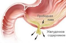 Небезпека проривної виразки шлунка і способи її лікування