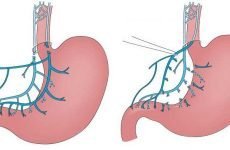 Ваготомія шлунка: показання, види, ускладнення