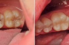 Чому болить зуб після лікування: причини та способи усунення болю