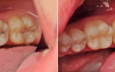 Чому болить зуб після лікування: причини та способи усунення болю