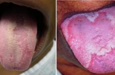 Лікування глоситу язика в домашніх умовах народними засобами