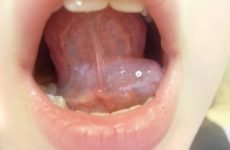 Шишка під язиком: причини, діагностика і методи лікування