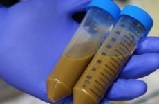 Дослідження на гельмінтози: лабораторна та диференціальна діагностика у людини, як здавати аналіз крові