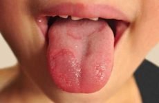 Десквамативний глосит (географічний язик) – причини, симптоми і способи лікування