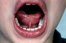 Підрізання вуздечки під язиком у дітей: показання та етапи операції