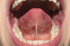 Шишка на вуздечці під язиком: причини появи та методи лікування