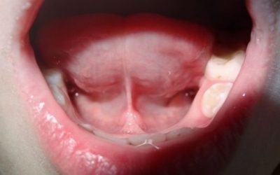 Болить вуздечка під язиком: причини і методи лікування