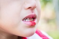Що робити, якщо дитина розбила губу? Лікуємо розпухлу зсередини губу.