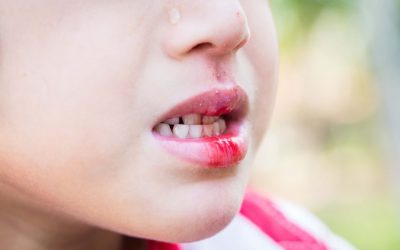 Що робити, якщо дитина розбила губу? Лікуємо розпухлу зсередини губу.