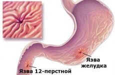 Основні симптоми виразкової хвороби шлунка і дванадцятипалої кишки