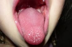Бульбашки на язиціі: причини появи та методи ефективного лікування