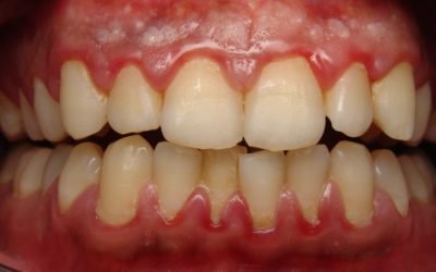Антибіотик при запаленні зубів і ясен: огляд ефективних засобів