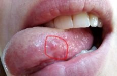 Шишка на язиці: причини виникнення, симптоми і методи лікування
