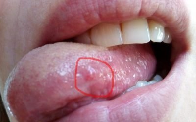 Шишка на язиці: причини виникнення, симптоми і методи лікування