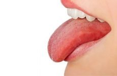 Який наліт може з’явитися на язиці при гастриті і як його прибрати?
