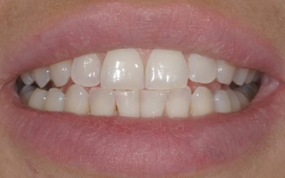 Вініри без обточування зубів: методика встановлення, переваги і недоліки