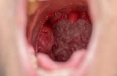 Запалення мигдалин і гланд в горлі у дітей: симптоми, діагностика, лікування та профілактика захворювання