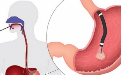 Фіброгастроскопія шлунка: підготовка, як роблять, протипоказання