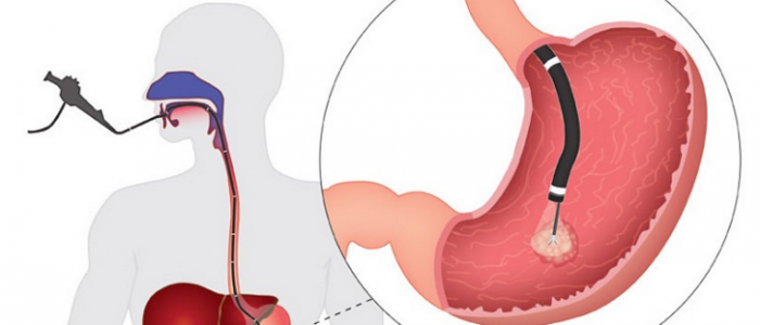 Фіброгастроскопія шлунка: підготовка, як роблять, протипоказання