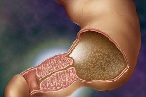 Воротар шлунка: лікування патологій, симптоми