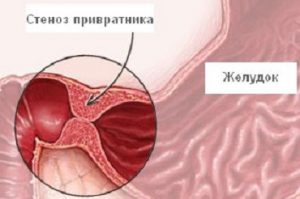 Воротар шлунка: лікування патологій, симптоми