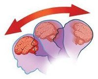 Признаки сотрясения мозга у взрослых и детей, последствия и прогноз специалиста