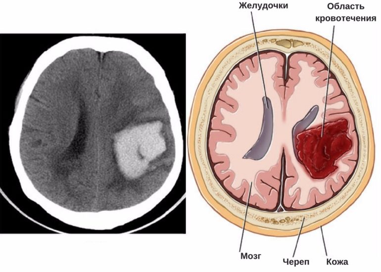 Инсульт головного мозга — какие последствия и прогноз жизни