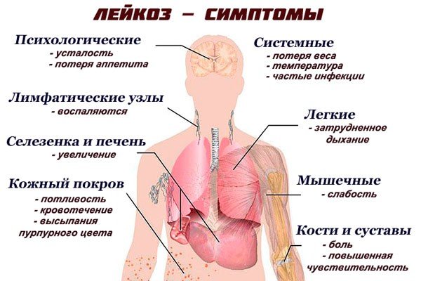 По каким признакам можно определить что у ребенка лейкоз и как лечат данную патологию