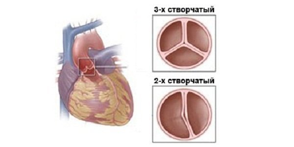 Строение аортального клапана сердца и почему возникают пороки АК?