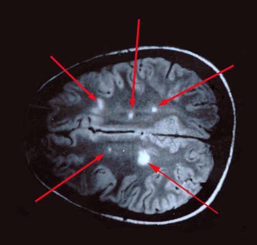 Демиелинизирующее заболевание головного мозга — симптомы, виды и лечение