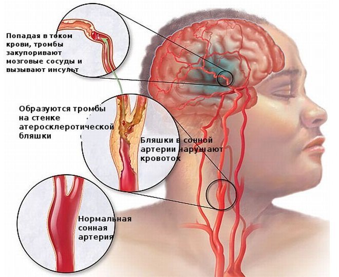 Инсульт головного мозга — какие последствия и прогноз жизни