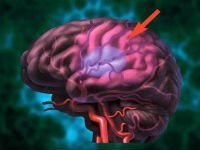 Почему сосуды мозга сужены и какие последствия это может вызвать?