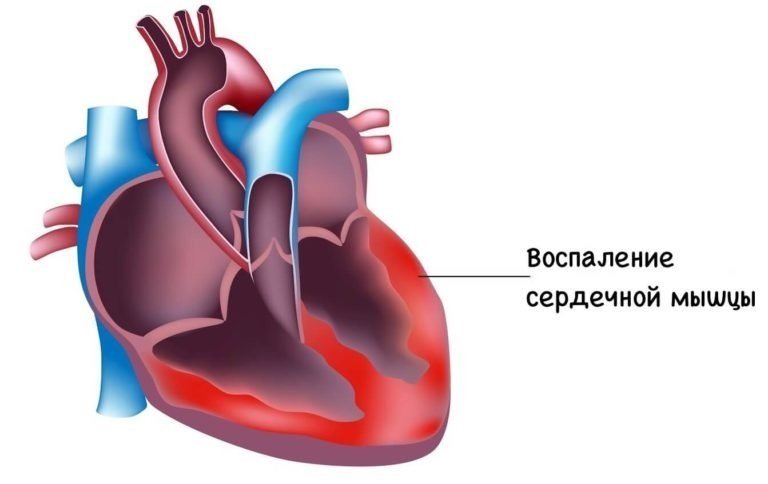 Что такое перкуссия сердца? Нормы для взрослых и детей