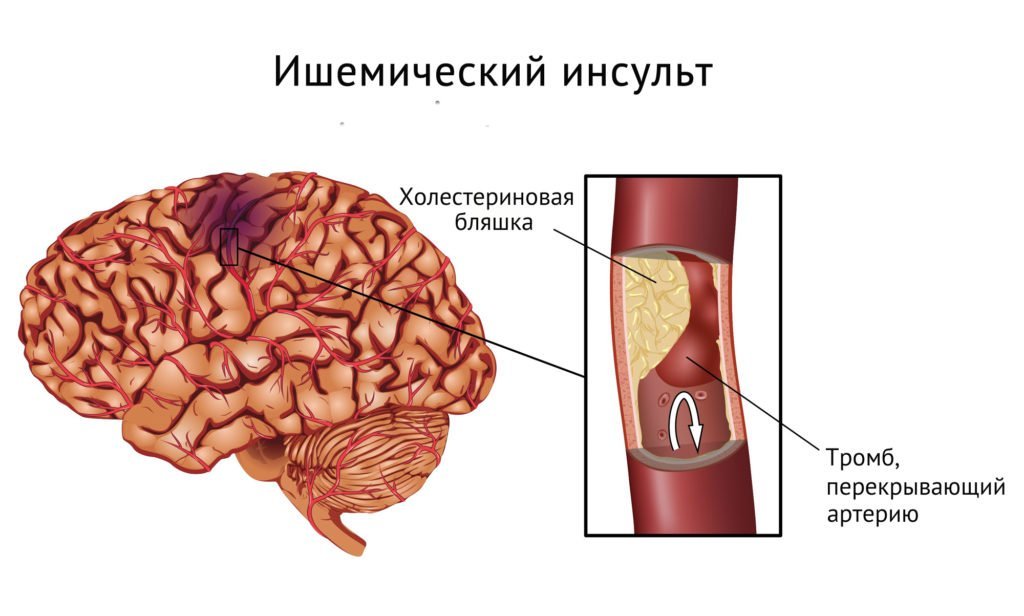 Как улучшить кровообращение сосудов мозга с помощью препаратов