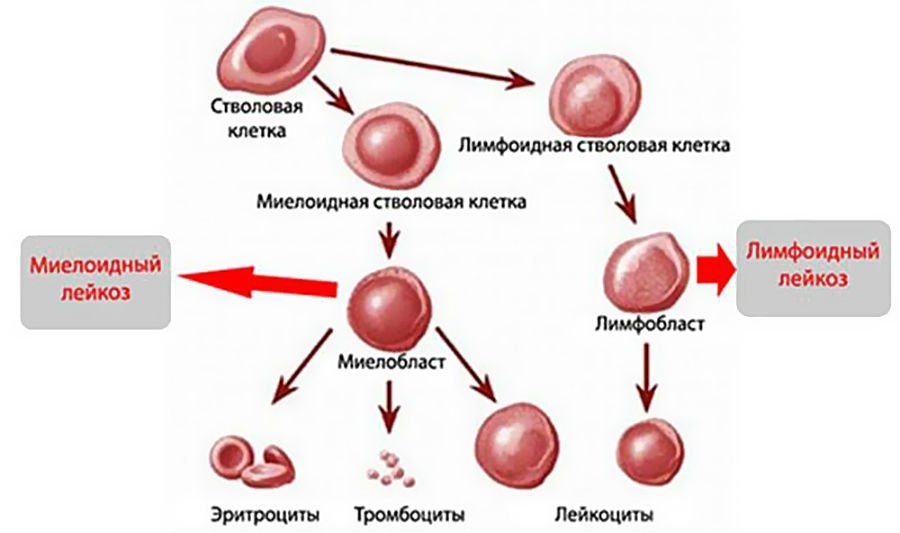 По каким признакам можно определить что у ребенка лейкоз и как лечат данную патологию