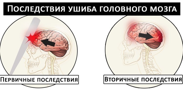 Классификация черепно-мозговых травм, их симптомы и лечение