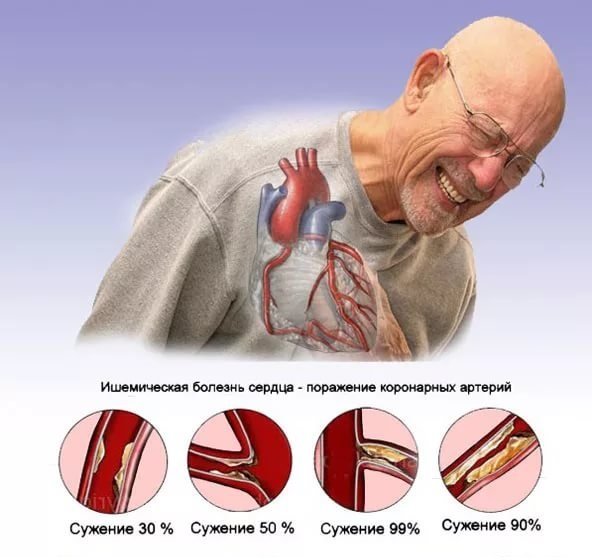 Анатомия коронарных артерий: функции, строение и механизм кровоснабжения