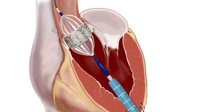 Строение аортального клапана сердца и почему возникают пороки АК?