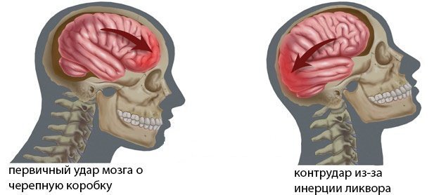 Классификация черепно-мозговых травм, их симптомы и лечение