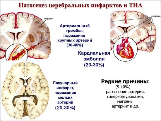 Транзиторная ишемическая атака головного мозга