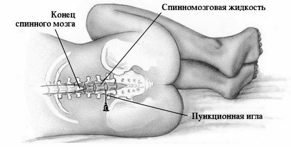 По каким признакам можно определить что у ребенка лейкоз и как лечат данную патологию